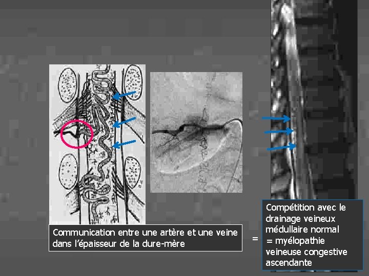 Communication entre une artère et une veine dans l’épaisseur de la dure-mère Compétition avec