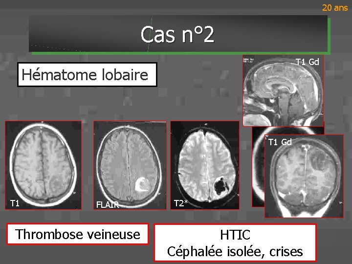 20 ans Cas n° 2 T 1 Gd Hématome lobaire 80 ans T 1