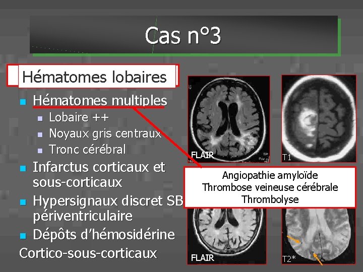 Cas n° 3 Angiopathie amyloïde Hématomes lobaires n Hématomes multiples n n n Lobaire