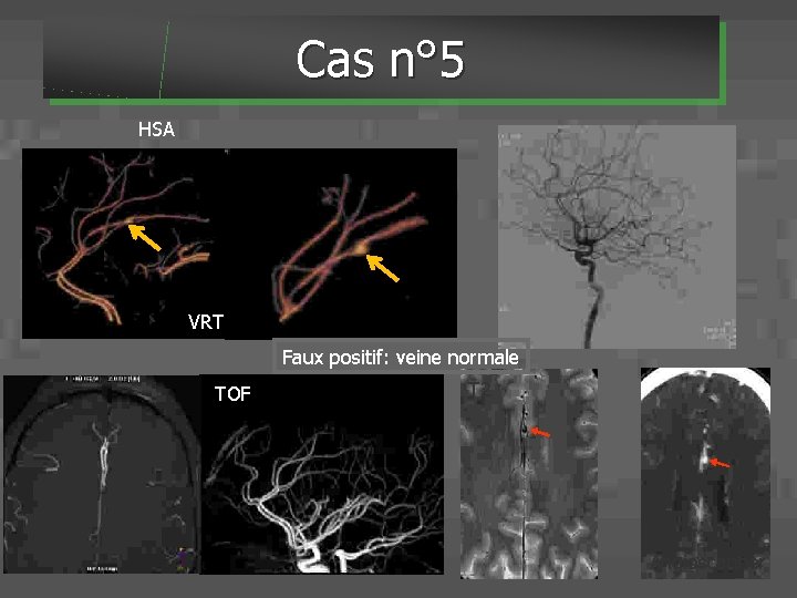 Cas n° 5 HSA VRT Faux positif: veine normale TOF T 2 Angioscanner 