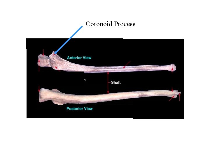 Coronoid Process 