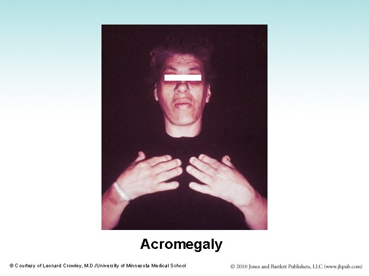 Acromegaly © Courtesy of Leonard Crowley, M. D. /University of Minnesota Medical School 