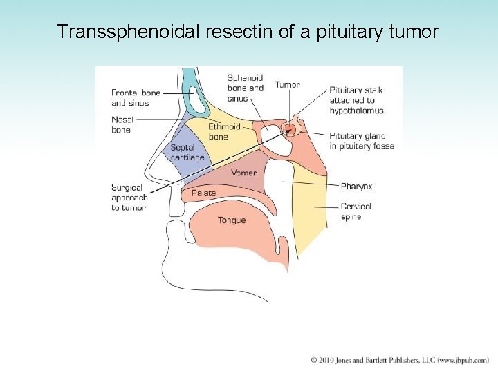 Transsphenoidal resectin of a pituitary tumor 