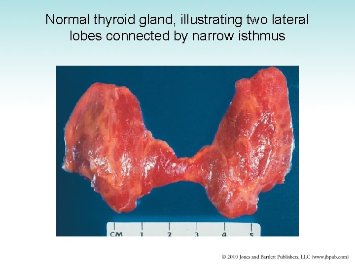 Normal thyroid gland, illustrating two lateral lobes connected by narrow isthmus 