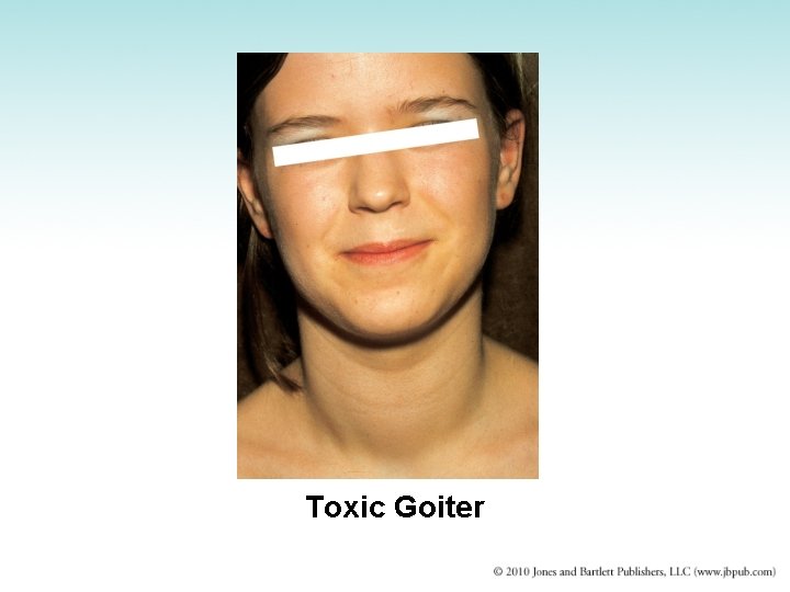 Toxic Goiter 