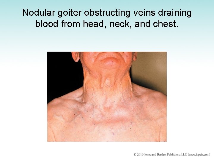 Nodular goiter obstructing veins draining blood from head, neck, and chest. 