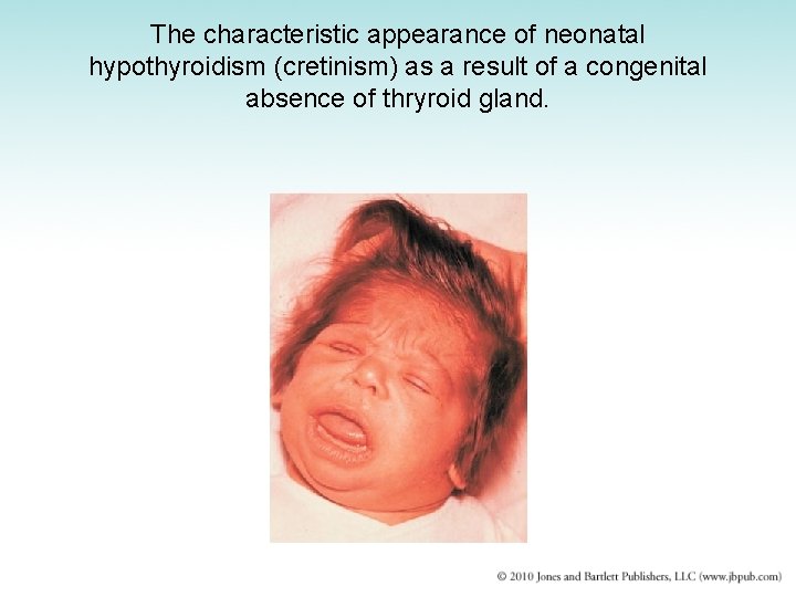 The characteristic appearance of neonatal hypothyroidism (cretinism) as a result of a congenital absence