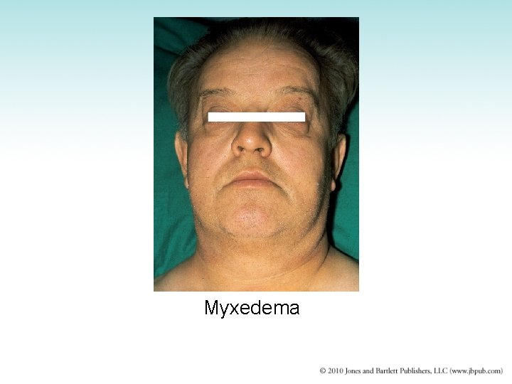 Myxedema 