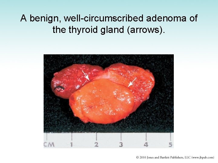 A benign, well-circumscribed adenoma of the thyroid gland (arrows). 