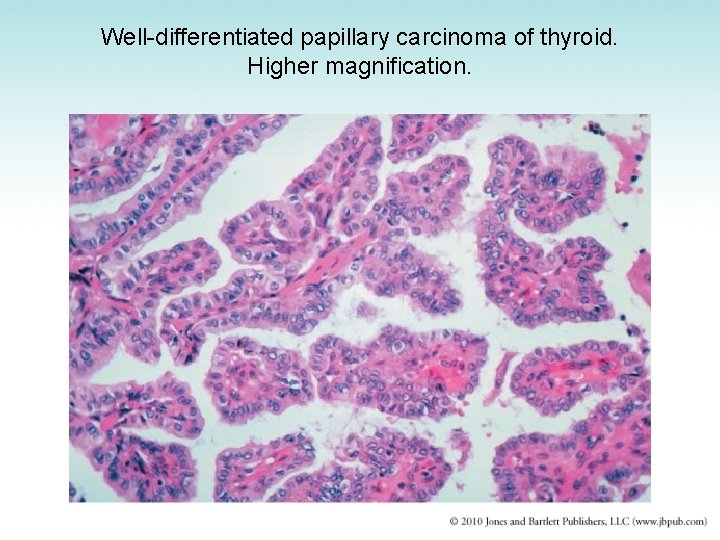 Well-differentiated papillary carcinoma of thyroid. Higher magnification. 