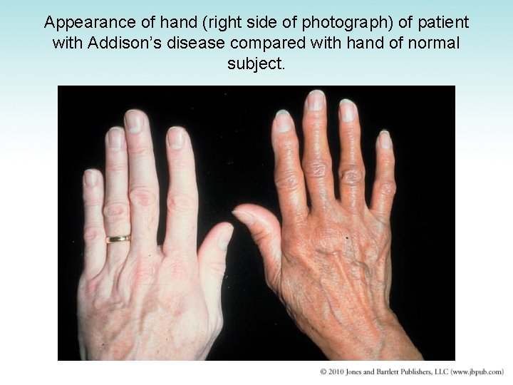 Appearance of hand (right side of photograph) of patient with Addison’s disease compared with