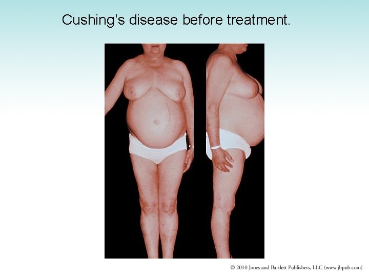 Cushing’s disease before treatment. 