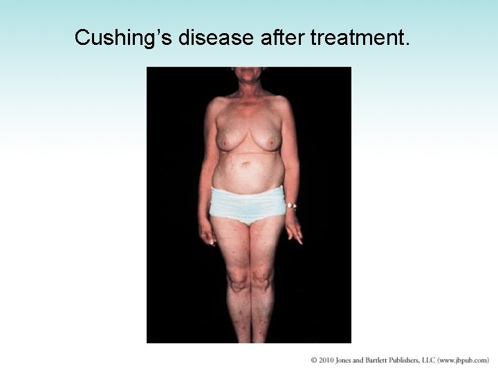 Cushing’s disease after treatment. 