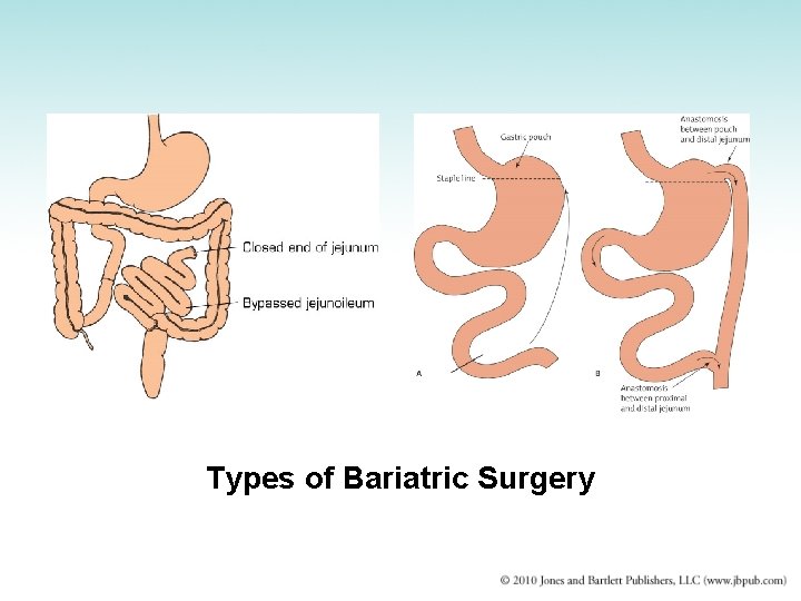 Types of Bariatric Surgery 