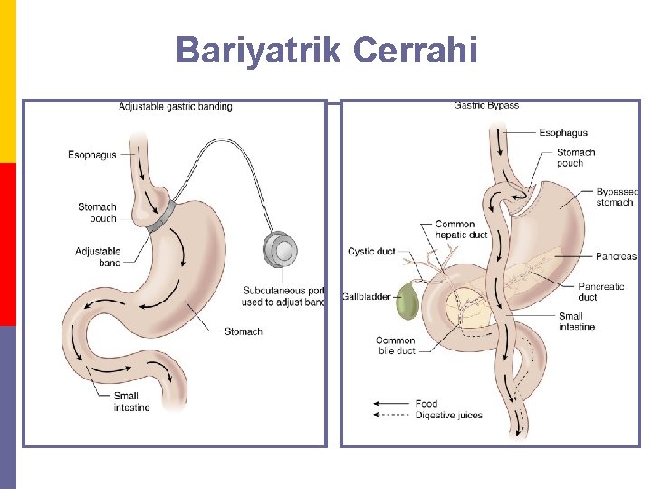 Bariyatrik Cerrahi 