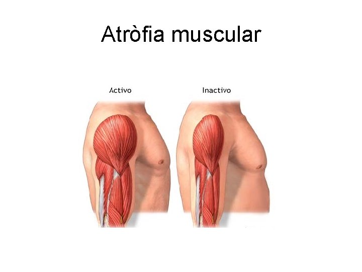 Atròfia muscular 