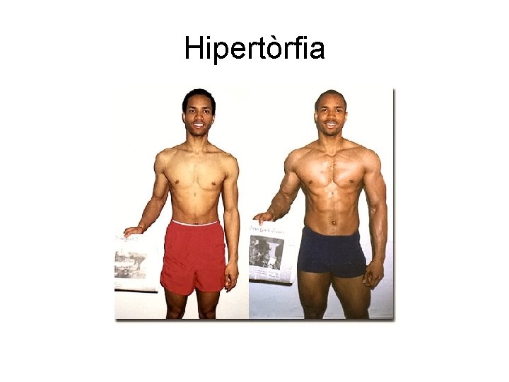 Hipertòrfia 