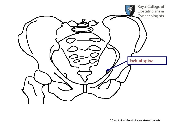 Ischial spine © Royal College of Obstetricians and Gynaecologists 