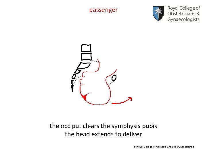 passenger the occiput clears the symphysis pubis the head extends to deliver © Royal