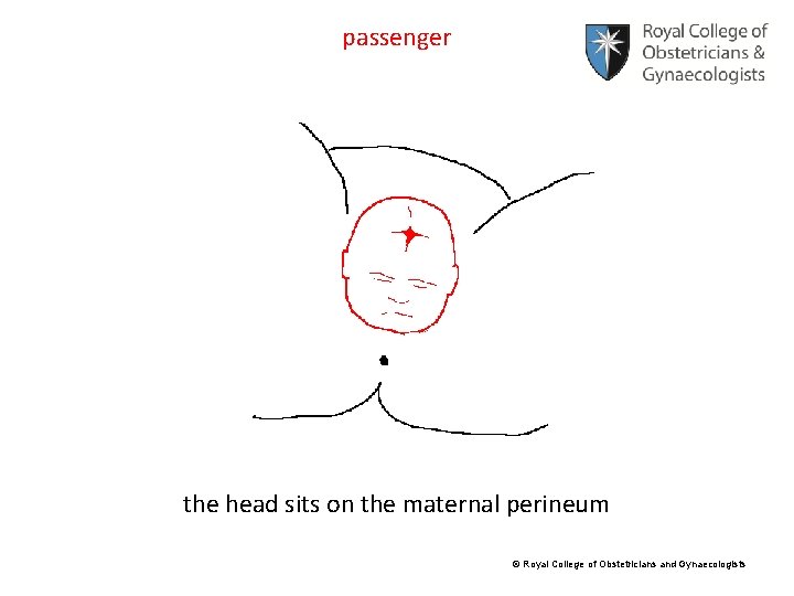 passenger the head sits on the maternal perineum © Royal College of Obstetricians and