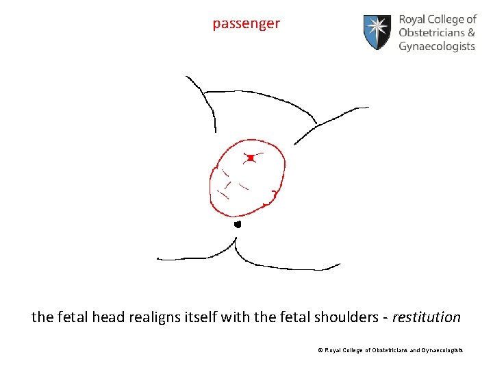 passenger the fetal head realigns itself with the fetal shoulders - restitution © Royal