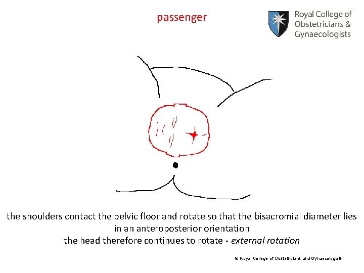 passenger the shoulders contact the pelvic floor and rotate so that the bisacromial diameter