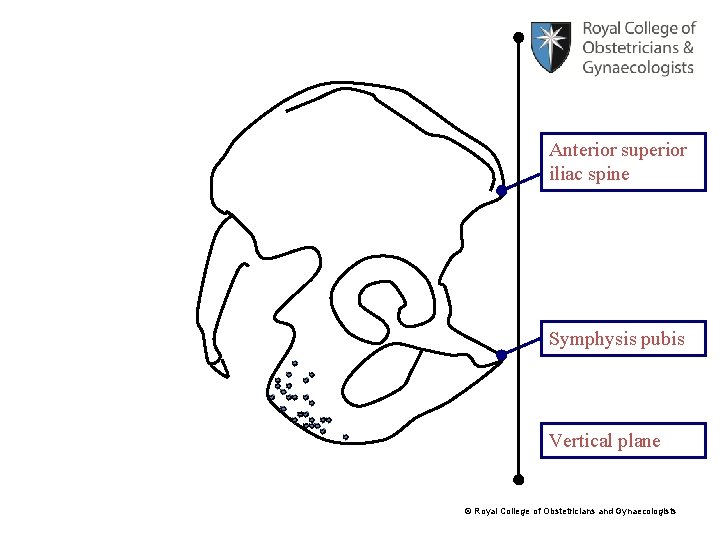 Anterior superior iliac spine Symphysis pubis Vertical plane © Royal College of Obstetricians and