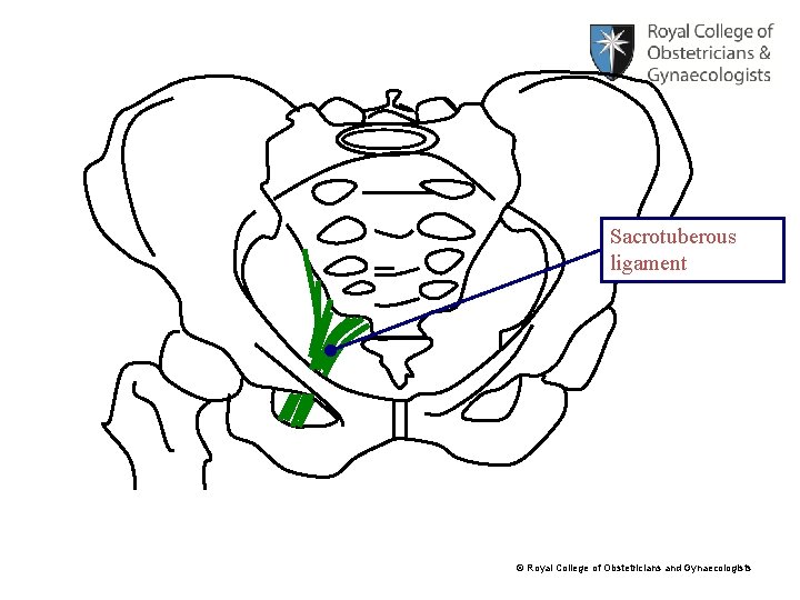 Sacrotuberous ligament © Royal College of Obstetricians and Gynaecologists 