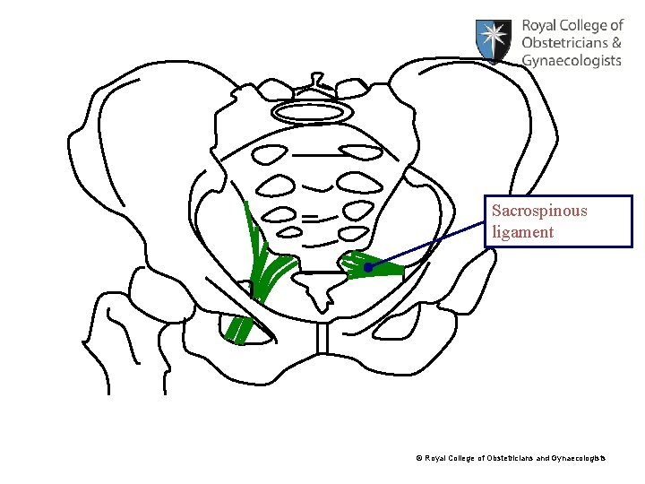 Sacrospinous ligament © Royal College of Obstetricians and Gynaecologists 