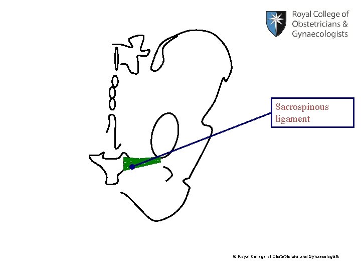 Sacrospinous ligament © Royal College of Obstetricians and Gynaecologists 