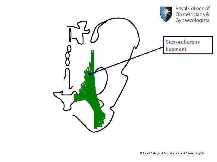 Sacrotuberous ligament © Royal College of Obstetricians and Gynaecologists 