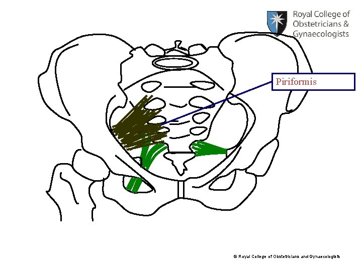 Piriformis © Royal College of Obstetricians and Gynaecologists 