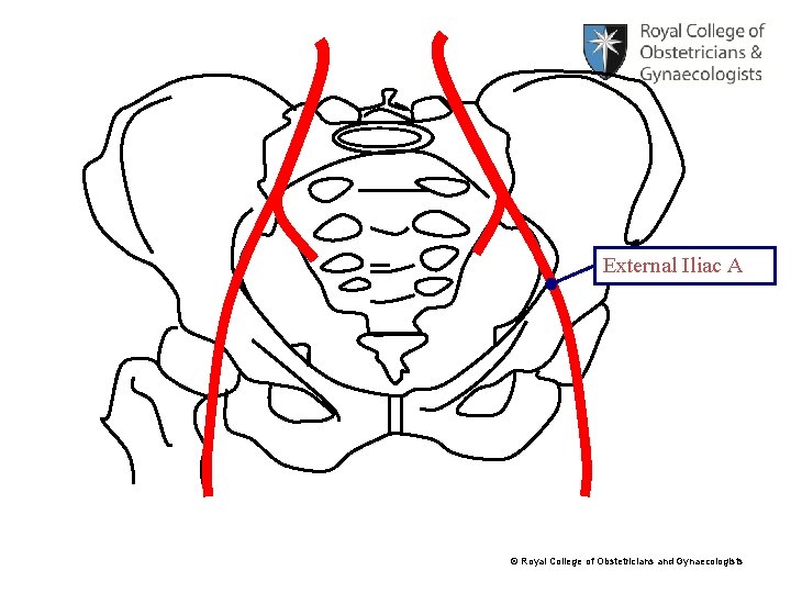 External Iliac A © Royal College of Obstetricians and Gynaecologists 
