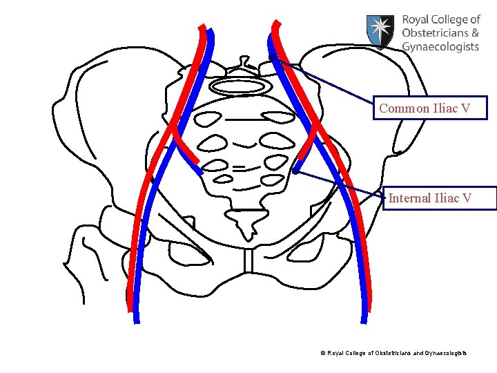 Common Iliac V Internal Iliac V © Royal College of Obstetricians and Gynaecologists 
