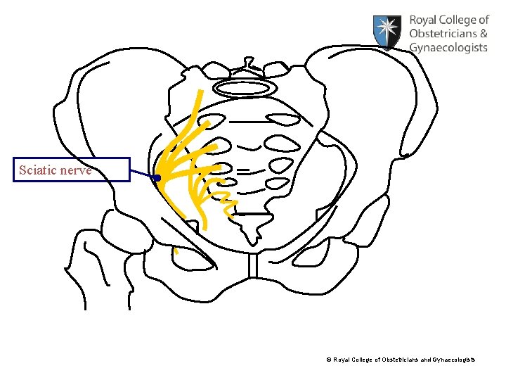 Sciatic nerve © Royal College of Obstetricians and Gynaecologists 