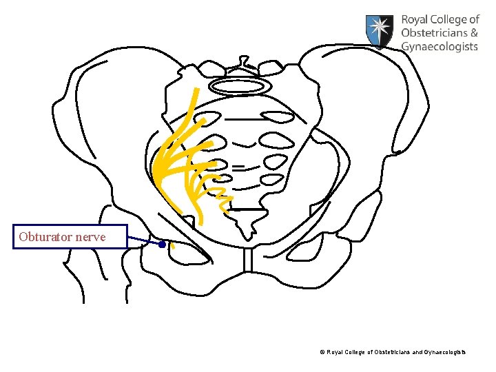 Obturator nerve © Royal College of Obstetricians and Gynaecologists 