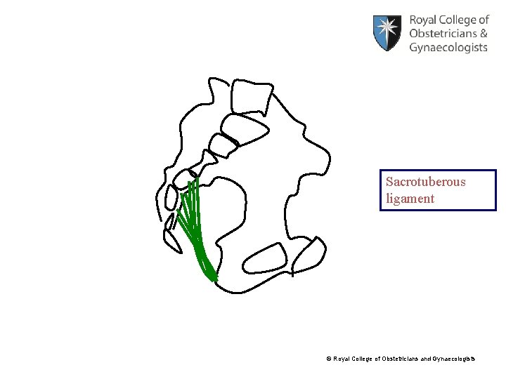 Sacrotuberous ligament © Royal College of Obstetricians and Gynaecologists 