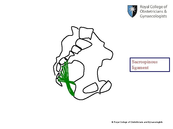 Sacrospinous ligament © Royal College of Obstetricians and Gynaecologists 