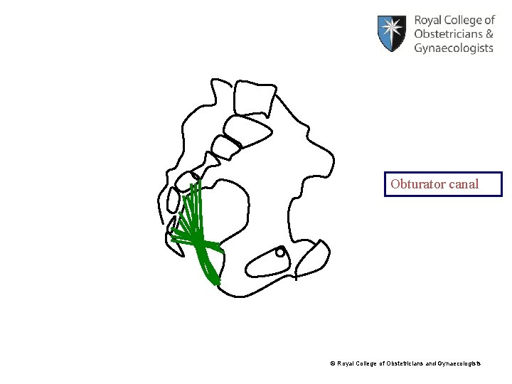 Obturator canal © Royal College of Obstetricians and Gynaecologists 