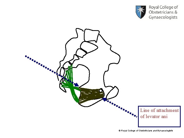 Line of attachment of levator ani © Royal College of Obstetricians and Gynaecologists 