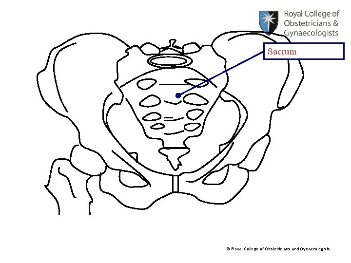 Sacrum © Royal College of Obstetricians and Gynaecologists 