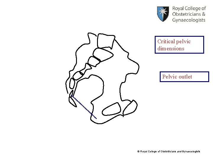Critical pelvic dimensions Pelvic outlet © Royal College of Obstetricians and Gynaecologists 