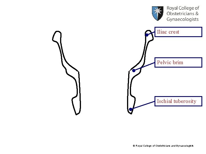 Iliac crest Pelvic brim Ischial tuberosity © Royal College of Obstetricians and Gynaecologists 