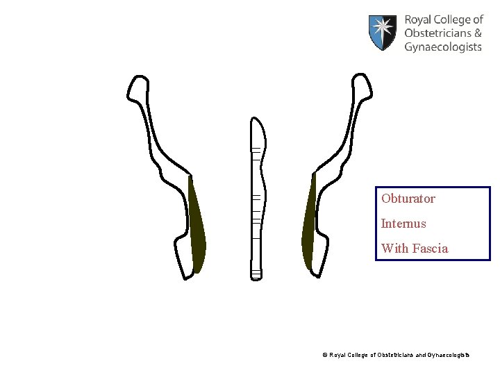 Obturator Internus With Fascia © Royal College of Obstetricians and Gynaecologists 