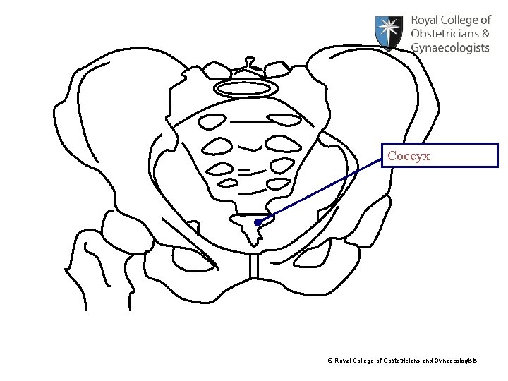 Coccyx © Royal College of Obstetricians and Gynaecologists 