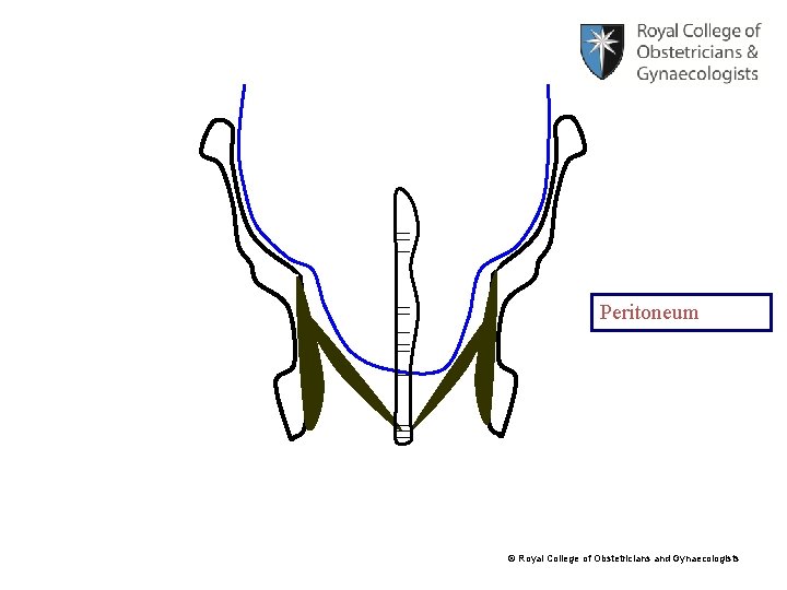 Peritoneum © Royal College of Obstetricians and Gynaecologists 