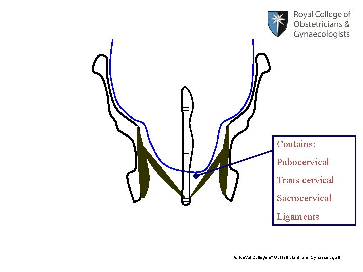 Contains: Pubocervical Trans cervical Sacrocervical Ligaments © Royal College of Obstetricians and Gynaecologists 