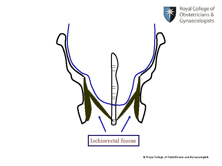 Ischiorectal fossae © Royal College of Obstetricians and Gynaecologists 