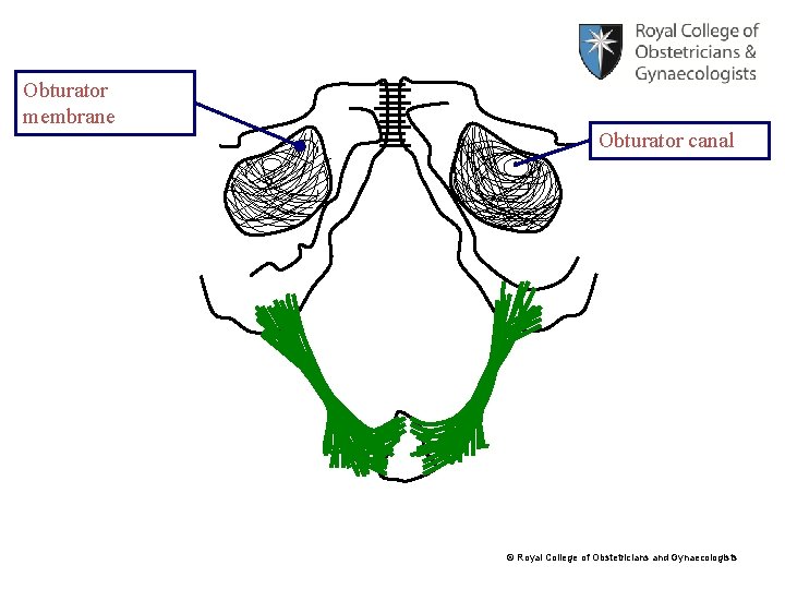 Obturator membrane Obturator canal © Royal College of Obstetricians and Gynaecologists 