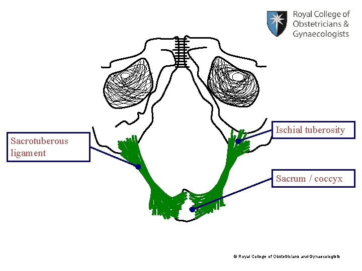 Sacrotuberous ligament Ischial tuberosity Sacrum / coccyx © Royal College of Obstetricians and Gynaecologists